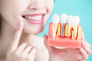 Image of a smiling patient with dental implants