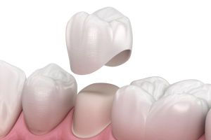 image of a dental crown 