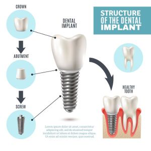 graphic showing the parts of a dental implant
