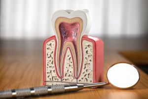 Root Canal Therapy Graphic
